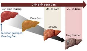 10 nguy cơ và dấu hiệu bệnh gan