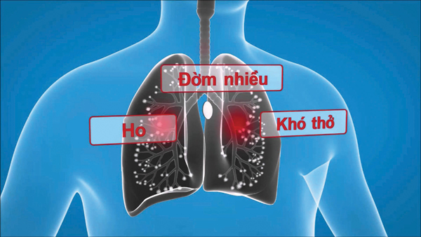 Phòng tái phát viêm phế quản mạn tính