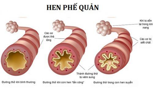 Phòng bệnh đường hô hấp thường gặp